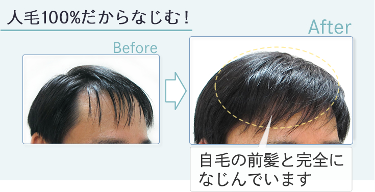 生え際を増毛 | はえぎわくん
