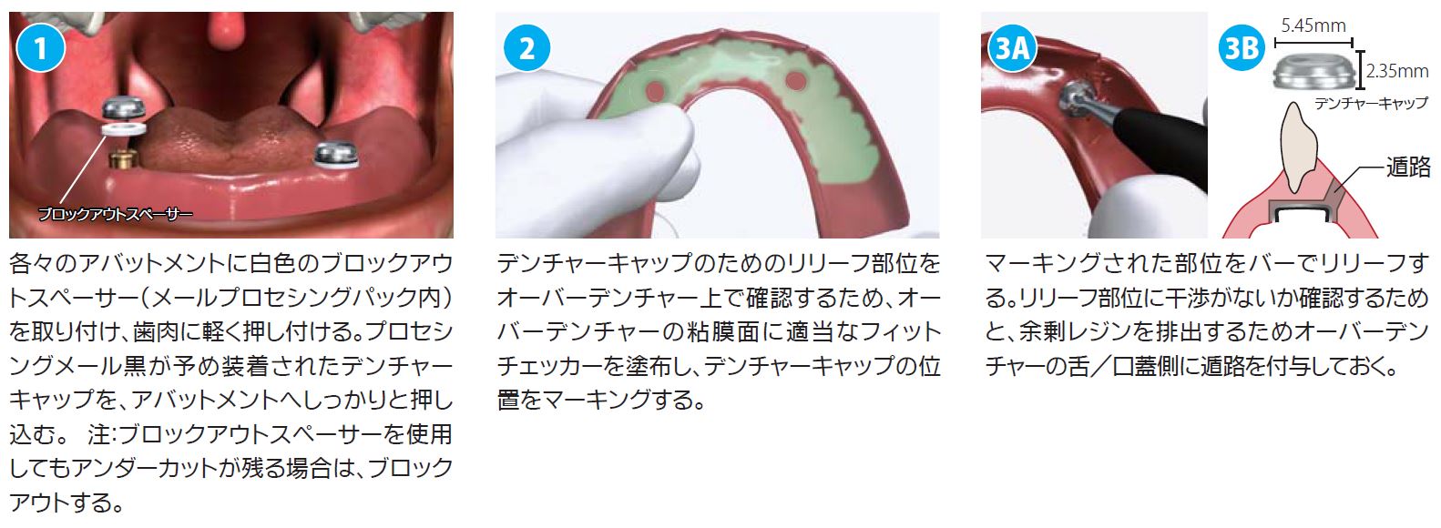 ロケーターアタッチメントシステム|株式会社インプラテックス