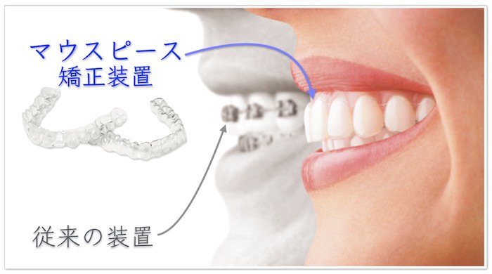 マウスピース矯正 インビザライン｜渋谷セントラル矯正歯科
