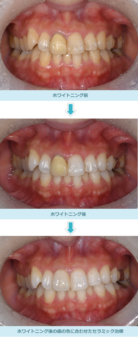 ホワイトニング｜診療案内｜向井歯科医院｜広島市南区段原の歯科