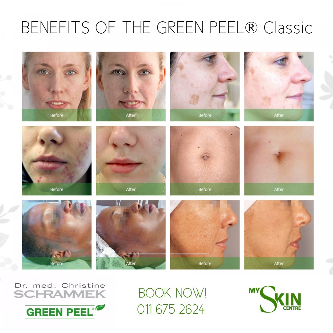 The original GREEN PEEL® Herbal Peeling Treatment Classic is the