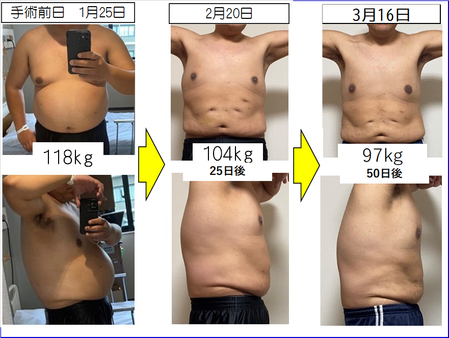 3/18朝 97.3kg(前日から-0.1kg) 以前体重停滞中…💦 手術から50日経過