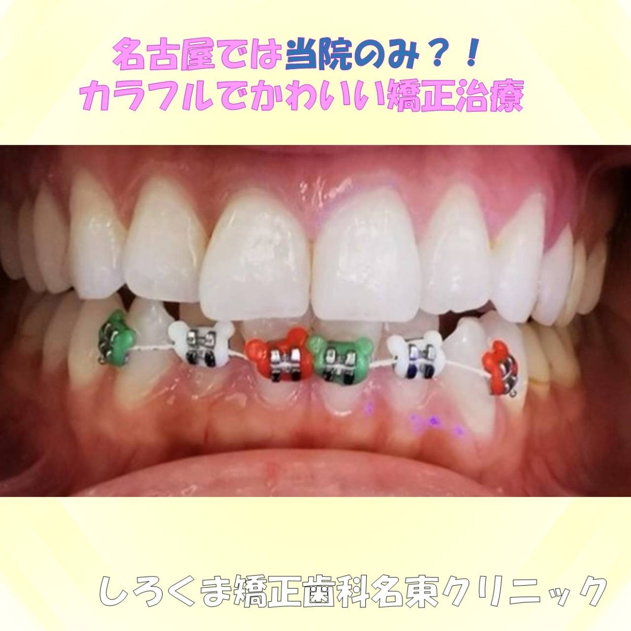 名古屋では当院のみ？！かわいいカラフル矯正🌈 | お口の美容と健康