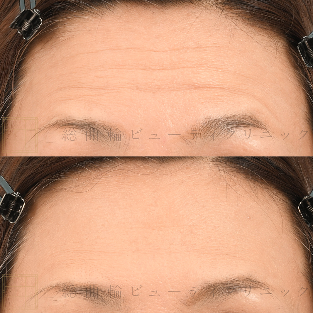 ヴィジョン・ド・ボーテ12個セット塗るボトックスおでこや目尻のシワに ヴィジョン・ド・ボーテ塗るボトックスおでこや目尻のシワに - メルカリ