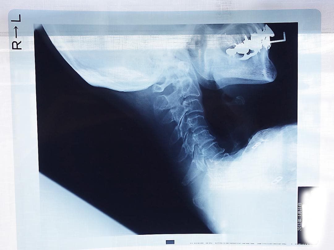 レントゲン写真　X線写真　　Z97 レントゲン画像や左足関節の X 線像 - 足首のストックフォトや画像を